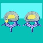 Herniated Disc Recovery Time - Herniated Disc